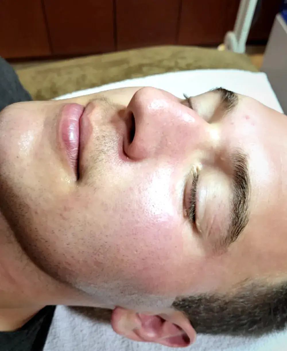 Microneedling in progress at Perfecta by Marina Stejar, North Scottsdale