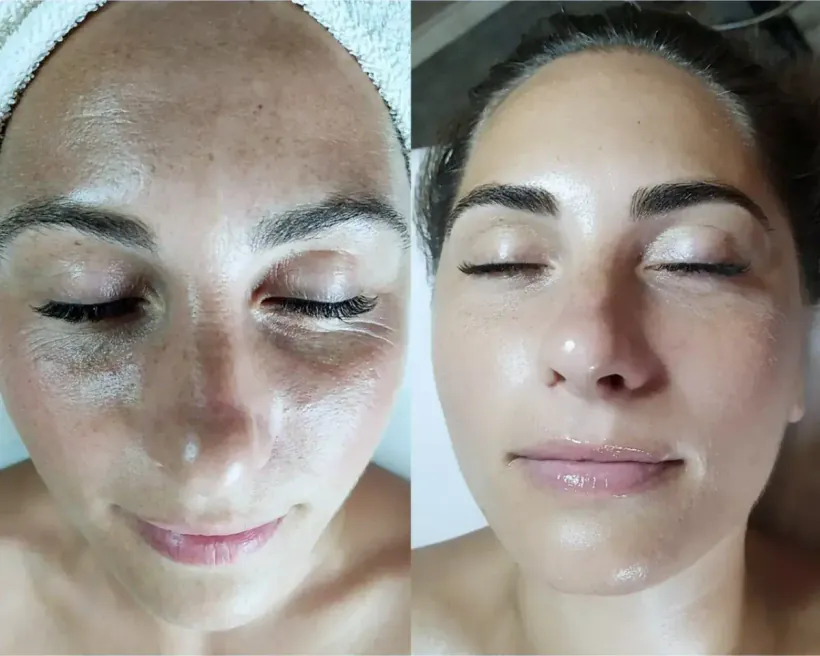 Congested, breakout-prone skin before and after a course of facials with esthetician Marina Stejar in Scottsdale, Arizona