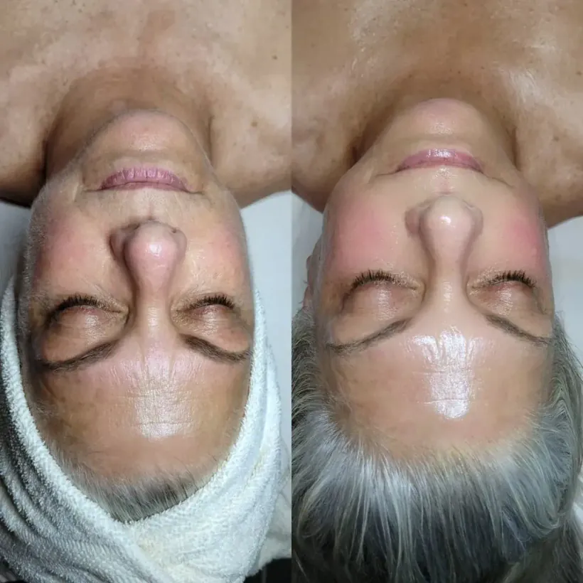 Clearer, calmer skin after an advanced facial with hydrodermabrasion — Marina Stejar, North Scottsdale