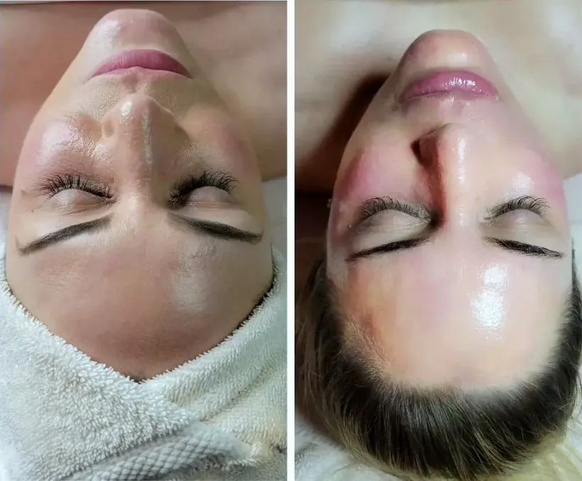 Uneven tone and surface pigmentation before and after an advanced facial with Marina Stejar, Scottsdale AZ