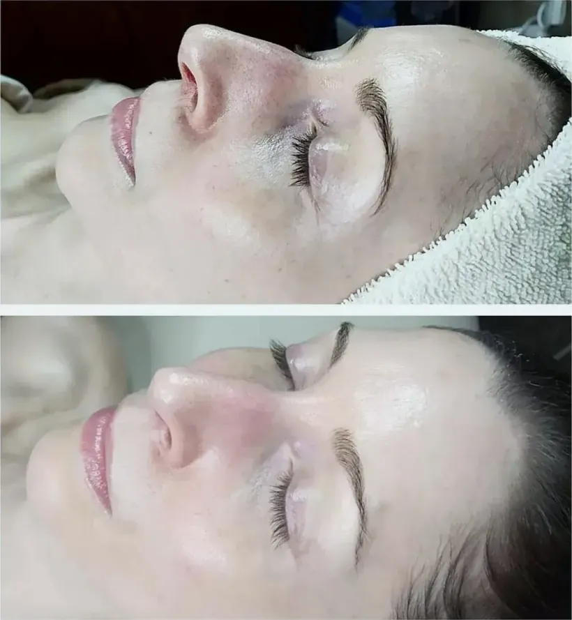 Profile before and after an advanced facial, showing cheek and jawline hydration — Scottsdale, Arizona
