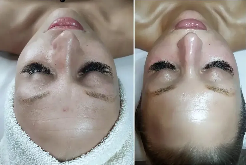 Advanced facial results after two treatments — before and after photographs taken in the same Scottsdale treatment room
