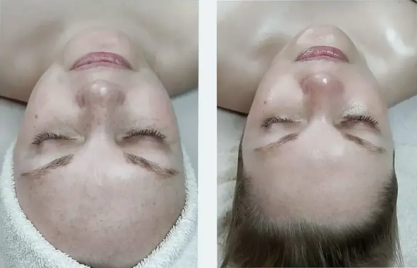 Customized facial before and after, North Scottsdale — exfoliation and extractions chosen for the client’s skin that day