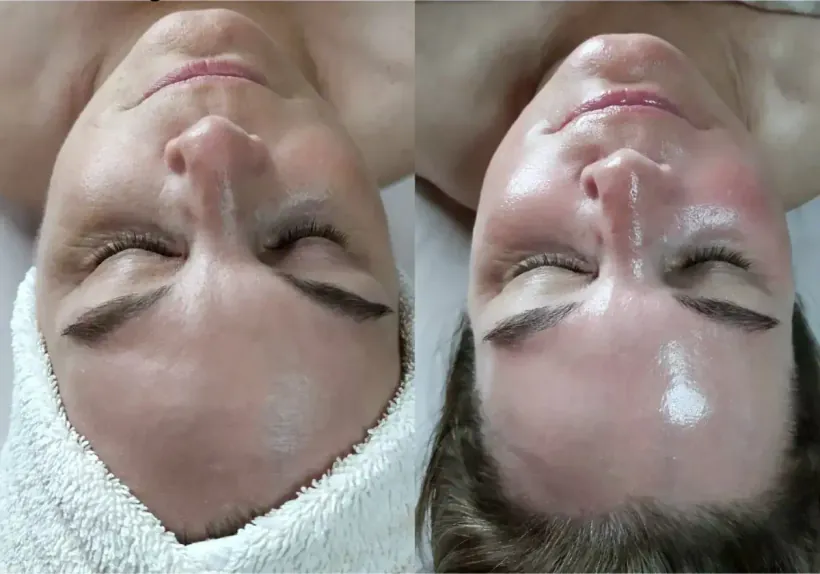 Dermaplaning combined with an extended hydrodermabrasion facial, before and after, at Marina Stejar’s Scottsdale studio
