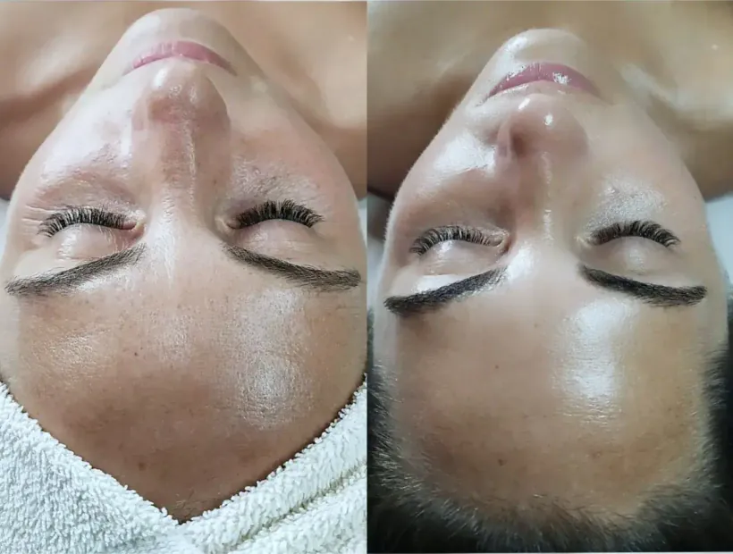 Before and after a hydrodermabrasion facial at Perfecta by Marina Stejar, North Scottsdale AZ — pores decongested, skin brighter the same day