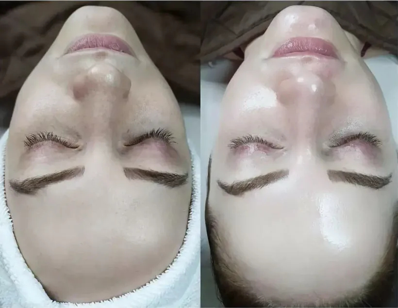 Hydrodermabrasion facial on mature skin, before and after, at Perfecta by Marina Stejar in Scottsdale AZ