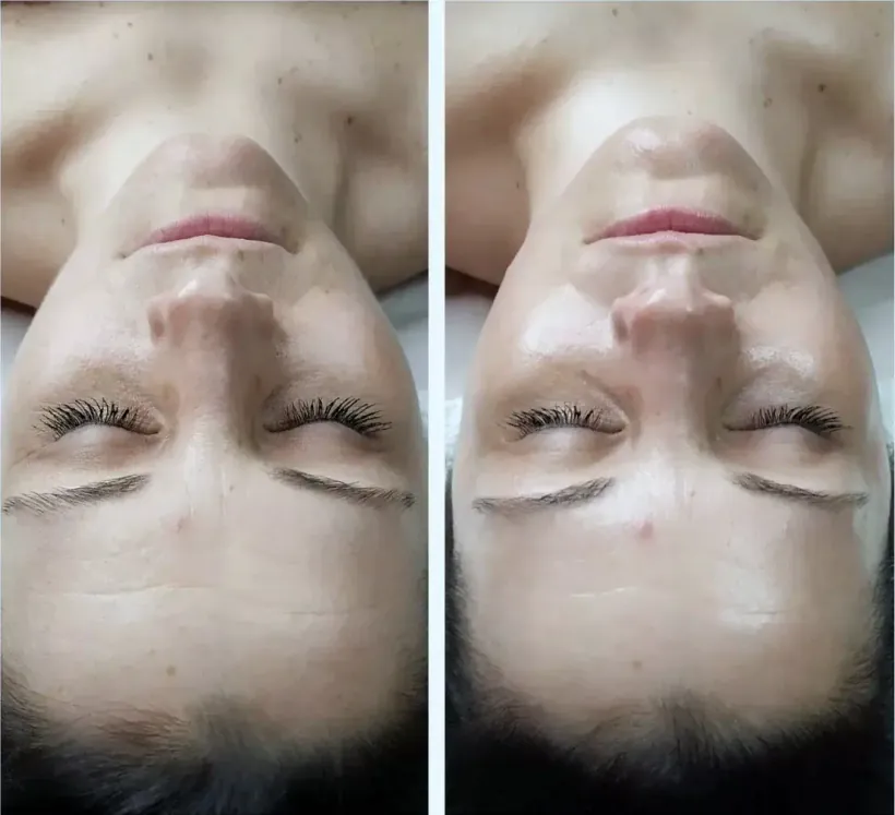 Skin texture before and after hydrodermabrasion, photographed under the same studio lighting in North Scottsdale