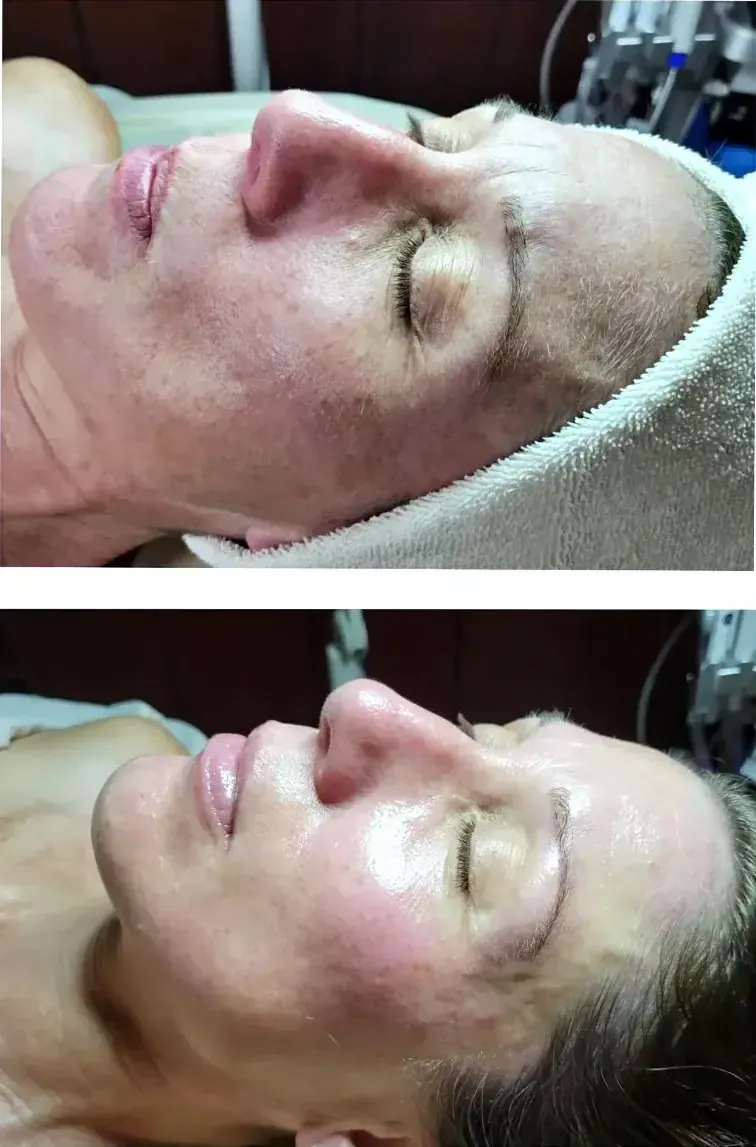 Mature skin before and after a customised facial at Perfecta by Marina Stejar, licensed esthetician in Scottsdale