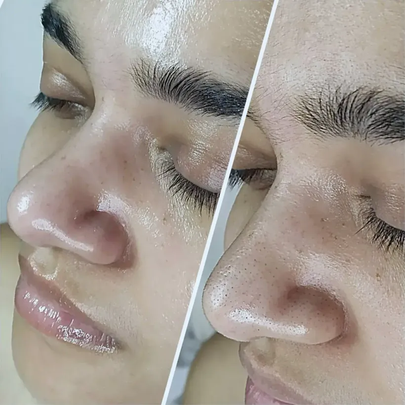 Close-up before and after of extractions around the nose during a hydrodermabrasion facial, North Scottsdale